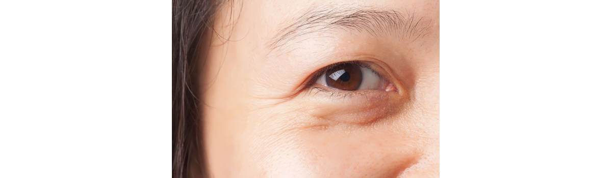 Thâm Mắt - Bọng Mắt