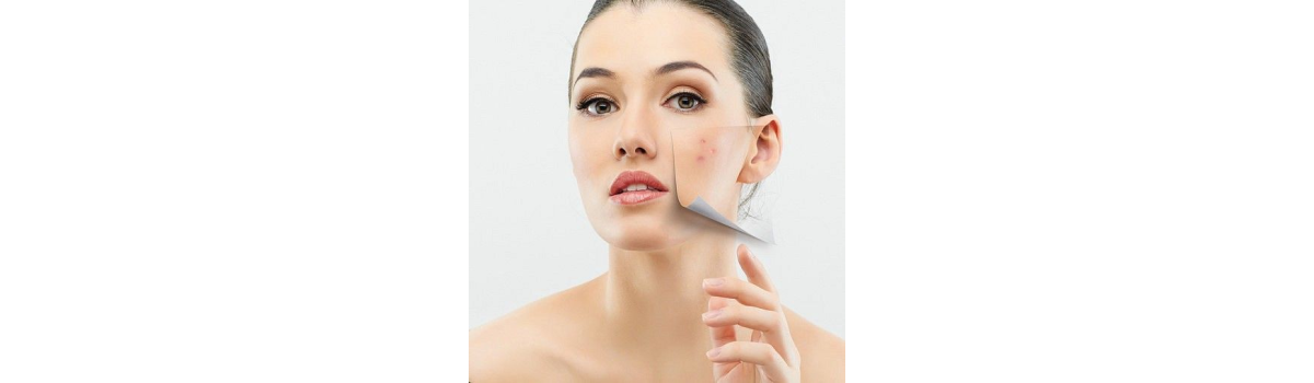 Điều Trị Mụn