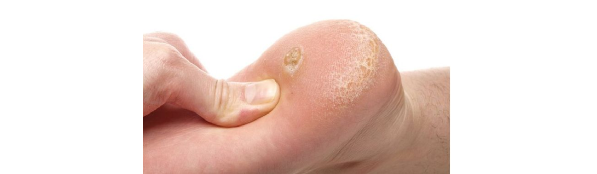 Nốt Ruồi - Mụn Cóc