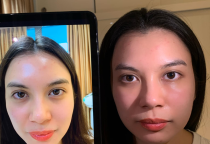 Trẻ Hóa Vùng Mắt 