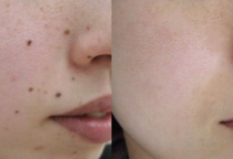 Nốt Ruồi - Mụn Cóc
