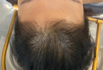  Cấy Tóc Tự Thân Có Bị Rụng Lại Không?