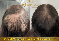 Chi Phí Cấy Tóc Tự Thân Tại DR4YOU – Bao Nhiêu Là Đủ?