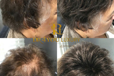 TÓC HÓI RỤNG TỪNG MẢNG LỚN CÓ SỬ DỤNG PHƯƠNG PHÁP CẤY TẠI DR4 YOU ĐƯỢC HAY KHÔNG?