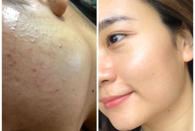 Điều Trị Mụn Uy Tín Quận 2