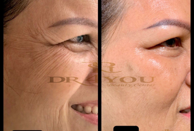 Trẻ Hóa Da Công Nghệ Cao Hiệu Quả Tại Dr4You – Bác Sĩ Da Liễu Uy Tín