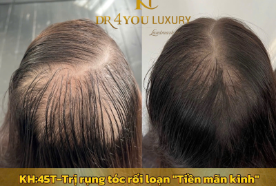 Chi Phí Cấy Tóc Tự Thân Tại DR4YOU – Bao Nhiêu Là Đủ?
